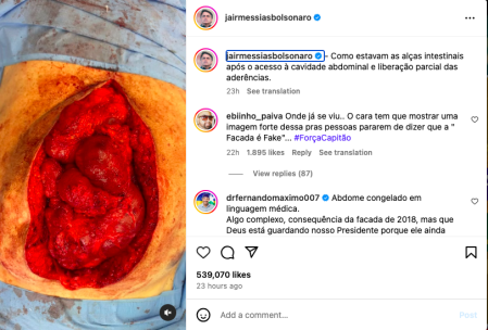 Post de instagram de Bolsonaro con la imagen de su intestino